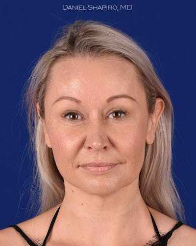 Female Rhinoplasty Before & After Gallery - Patient 17365755 - Image 2