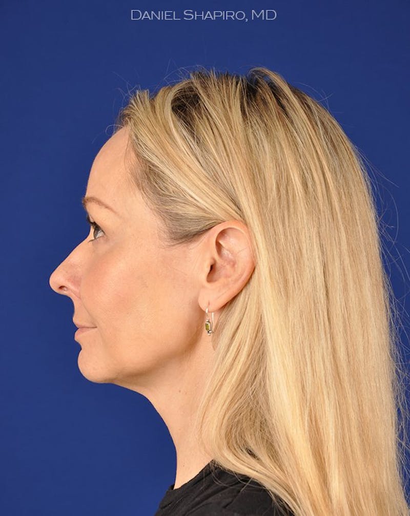 Female Rhinoplasty Before & After Gallery - Patient 17365755 - Image 5