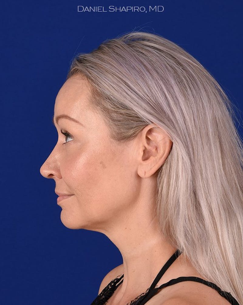 Female Rhinoplasty Before & After Gallery - Patient 17365755 - Image 6