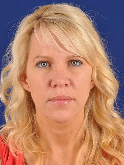 Female Rhinoplasty Before & After Gallery - Patient 17365758 - Image 2