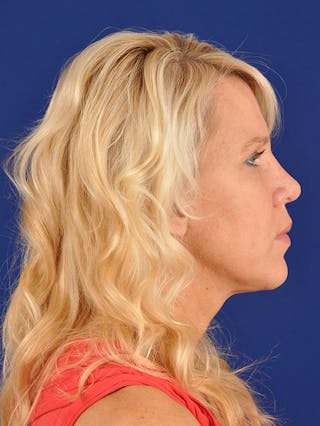 Female Rhinoplasty Before & After Gallery - Patient 17365758 - Image 6