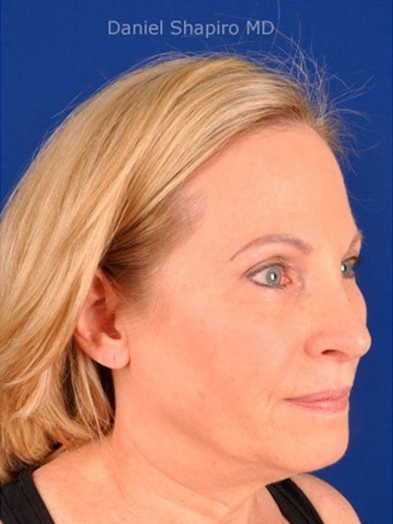 Female Rhinoplasty Before & After Gallery - Patient 17365759 - Image 4