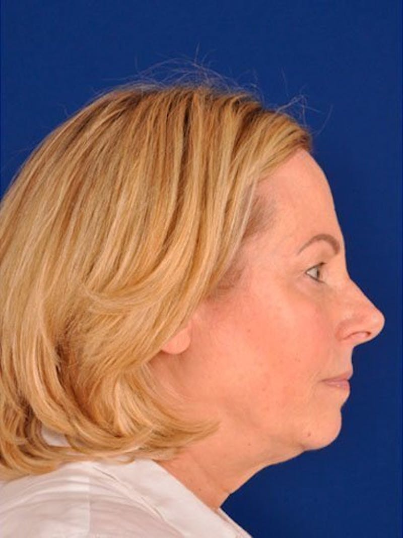 Female Rhinoplasty Before & After Gallery - Patient 17365759 - Image 5