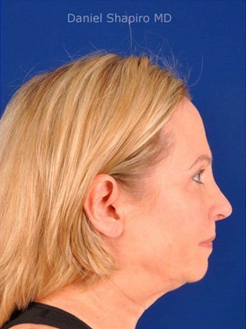 Female Rhinoplasty Before & After Gallery - Patient 17365759 - Image 6