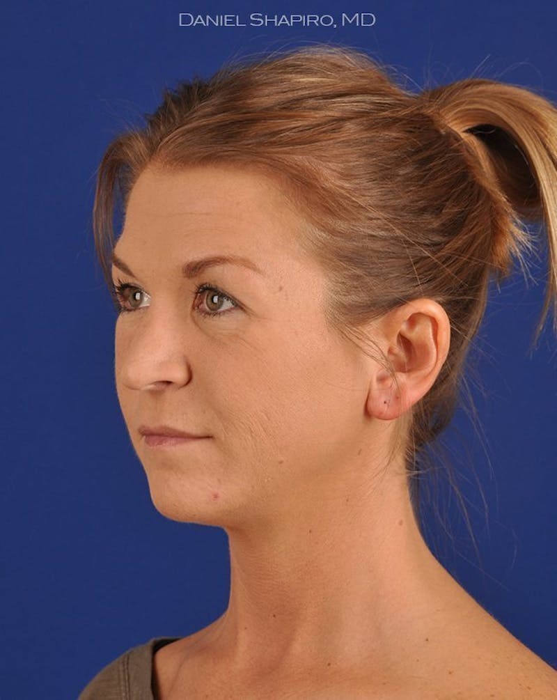 Female Rhinoplasty Before & After Gallery - Patient 17365760 - Image 3