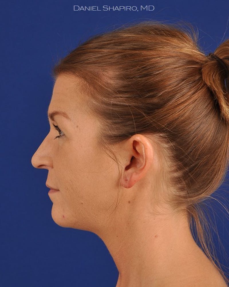 Female Rhinoplasty Before & After Gallery - Patient 17365760 - Image 5