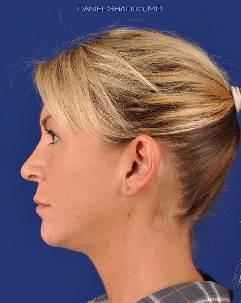 Female Rhinoplasty Before & After Gallery - Patient 17365760 - Image 6