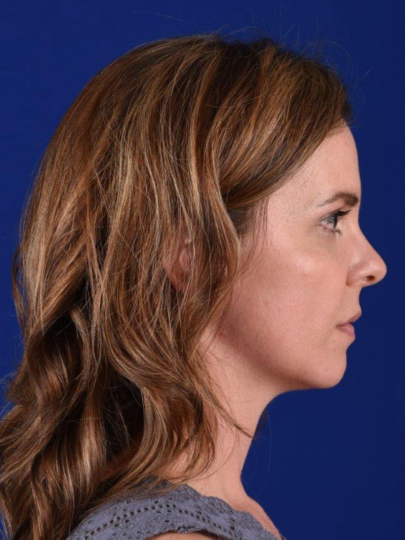 Female Rhinoplasty Before & After Gallery - Patient 17365762 - Image 5