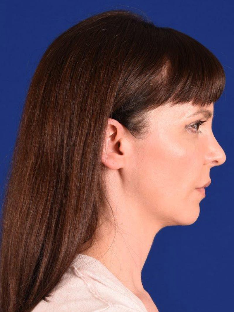 Female Rhinoplasty Before & After Gallery - Patient 17365762 - Image 6