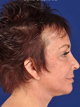 Female Rhinoplasty Before & After Gallery - Patient 17365764 - Image 6