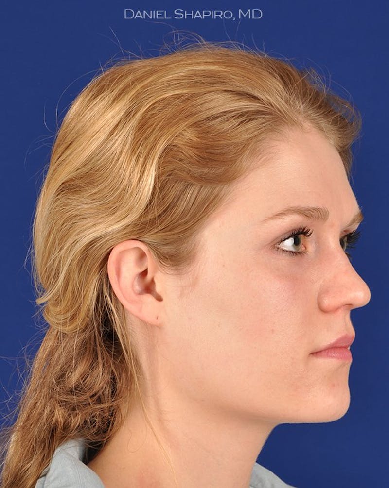 Female Rhinoplasty Before & After Gallery - Patient 17365768 - Image 3