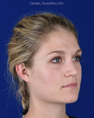 Female Rhinoplasty Before & After Gallery - Patient 17365768 - Image 4