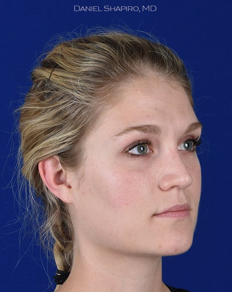 Female Rhinoplasty Before & After Gallery - Patient 17365768 - Image 4