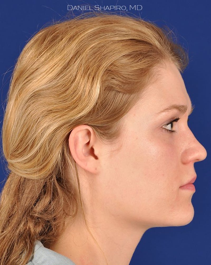 Female Rhinoplasty Before & After Gallery - Patient 17365768 - Image 5