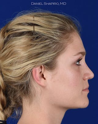 Female Rhinoplasty Before & After Gallery - Patient 17365768 - Image 6