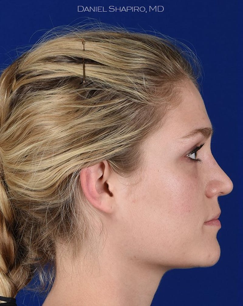 Female Rhinoplasty Before & After Gallery - Patient 17365768 - Image 6