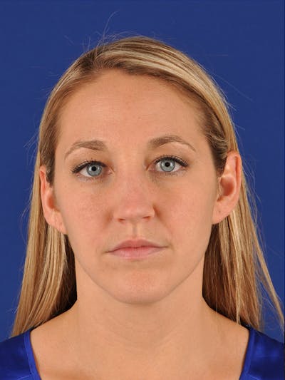 Female Rhinoplasty Before & After Gallery - Patient 17365773 - Image 1