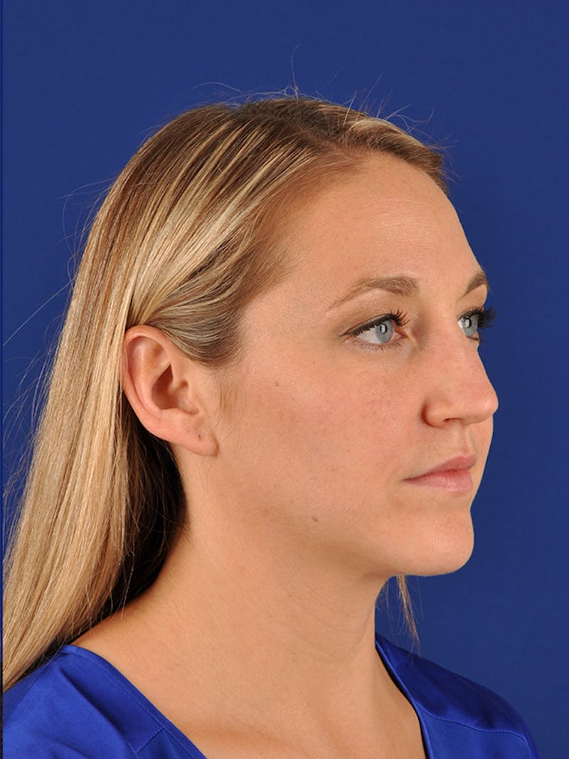 Female Rhinoplasty Before & After Gallery - Patient 17365773 - Image 3