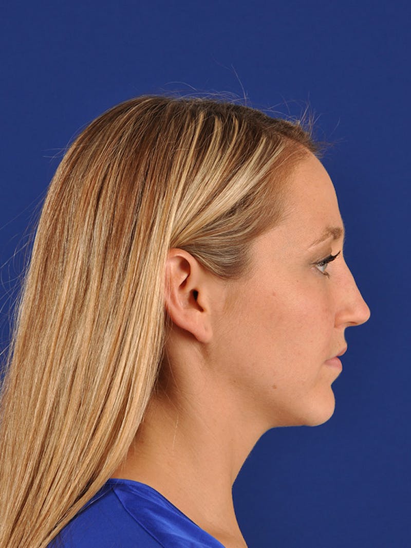 Female Rhinoplasty Before & After Gallery - Patient 17365773 - Image 5