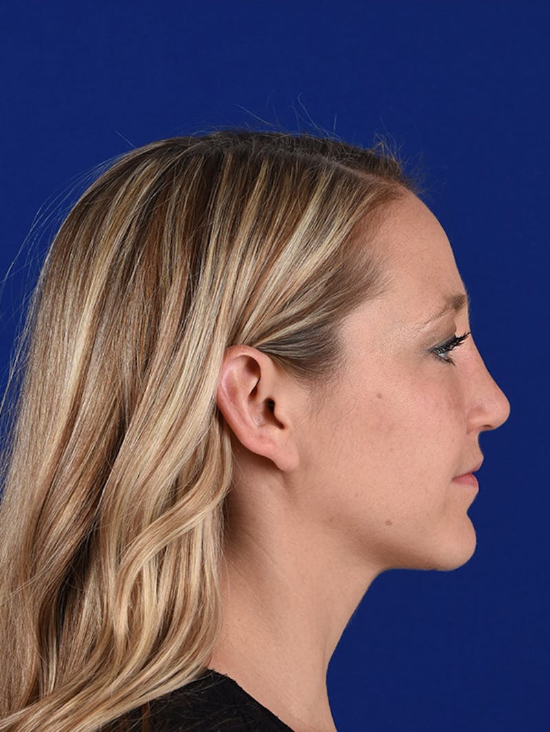 Female Rhinoplasty Before & After Gallery - Patient 17365773 - Image 6