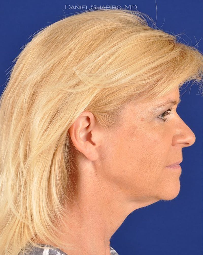 Female Rhinoplasty Before & After Gallery - Patient 17365776 - Image 5