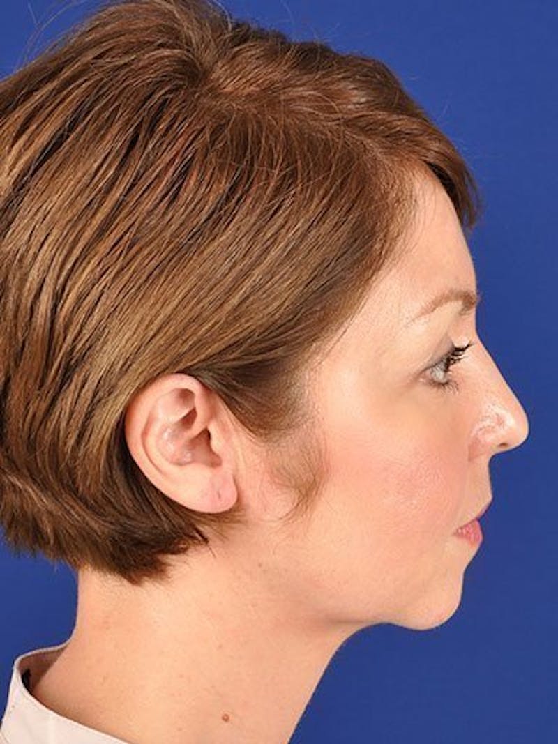 Female Rhinoplasty Before & After Gallery - Patient 17365778 - Image 5