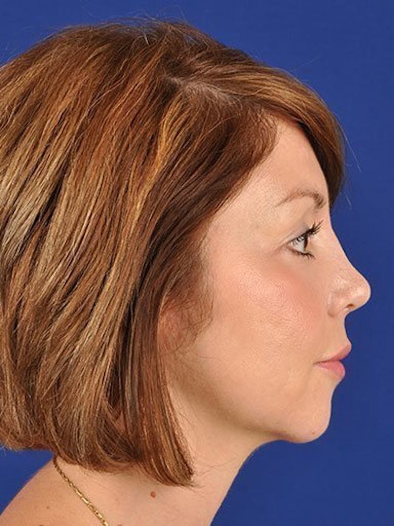Female Rhinoplasty Before & After Gallery - Patient 17365778 - Image 6