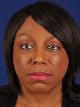 Female Rhinoplasty Before & After Gallery - Patient 17365779 - Image 2