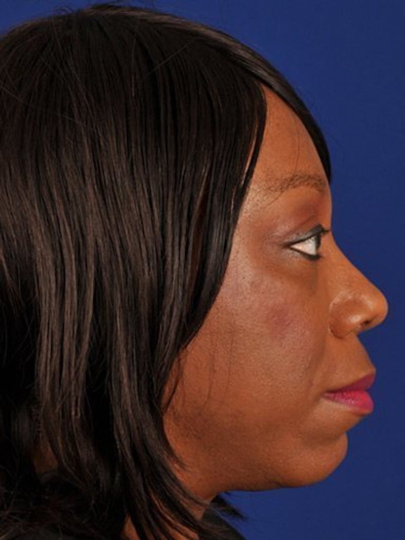 Female Rhinoplasty Before & After Gallery - Patient 17365779 - Image 6
