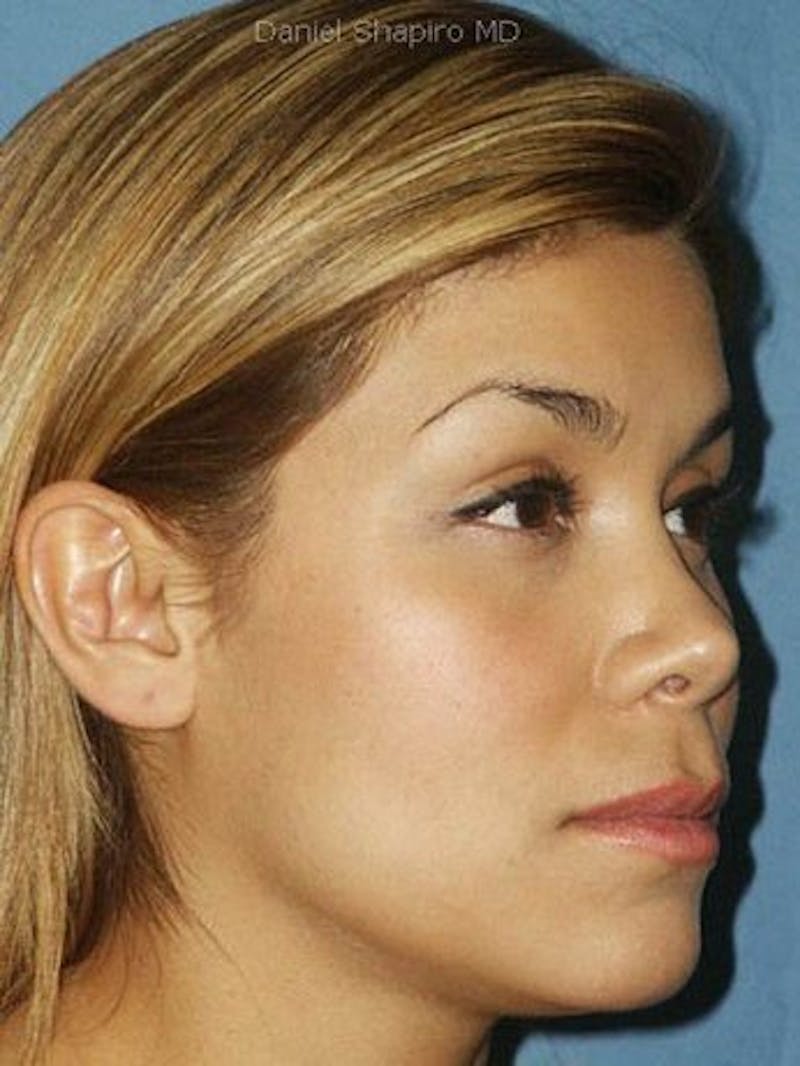 Female Rhinoplasty Before & After Gallery - Patient 17365780 - Image 2
