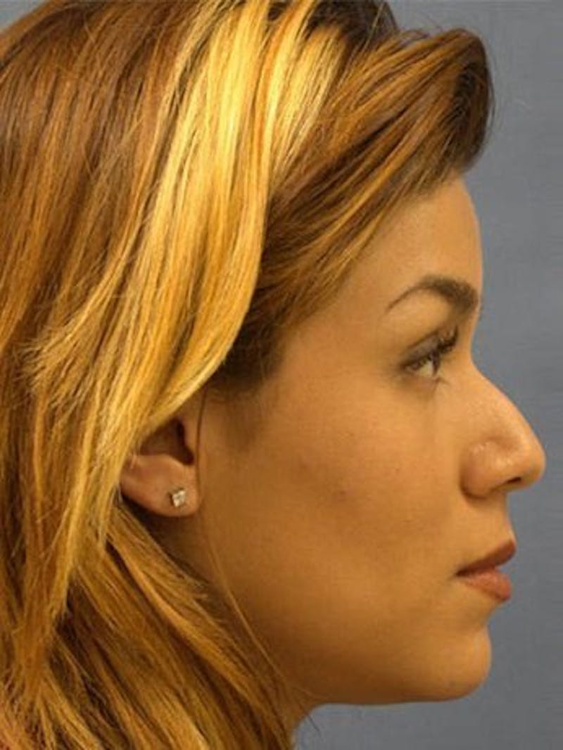 Female Rhinoplasty Before & After Gallery - Patient 17365780 - Image 3