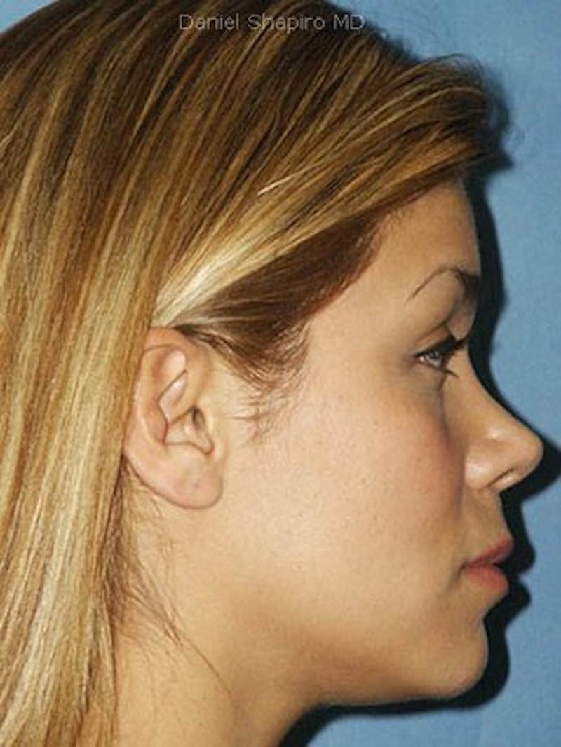 Female Rhinoplasty Before & After Gallery - Patient 17365780 - Image 4