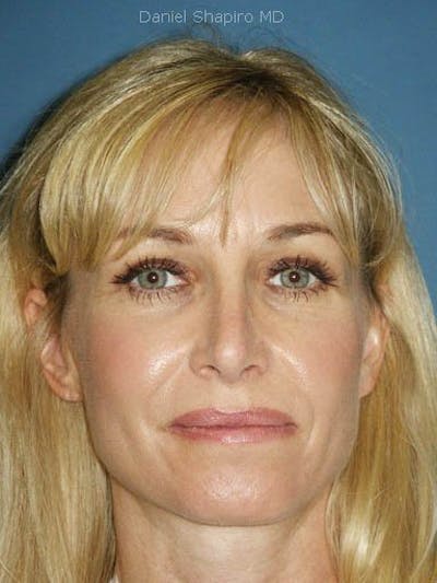 Female Rhinoplasty Before & After Gallery - Patient 17365783 - Image 2