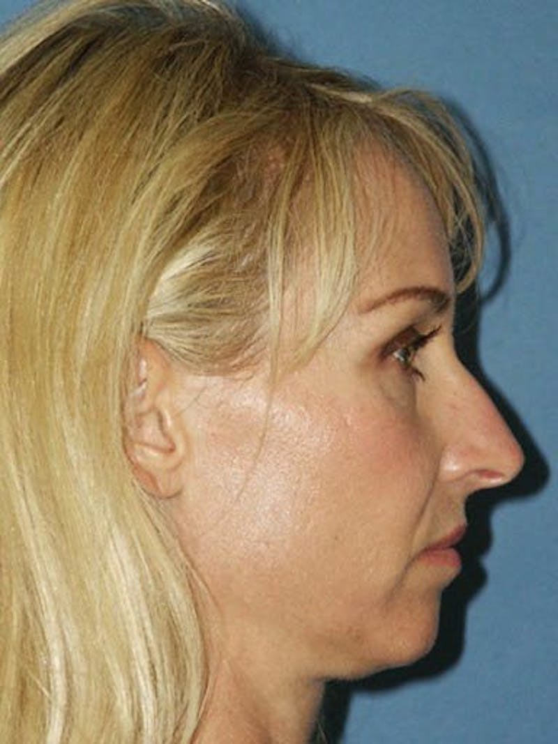 Female Rhinoplasty Before & After Gallery - Patient 17365783 - Image 3