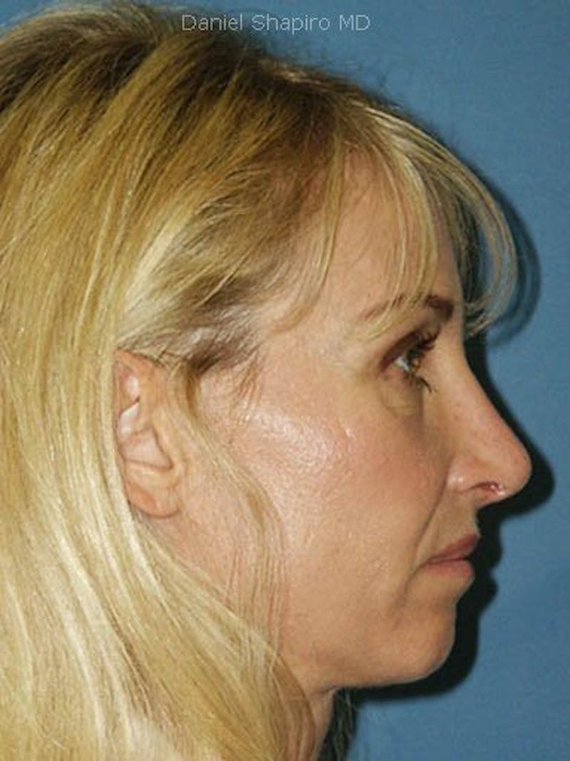Female Rhinoplasty Before & After Gallery - Patient 17365783 - Image 4