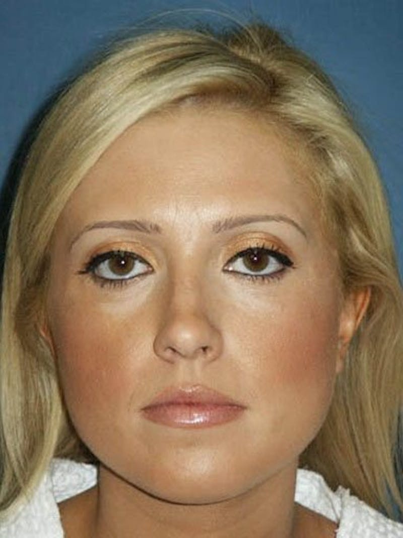Female Rhinoplasty Before & After Gallery - Patient 17365786 - Image 1