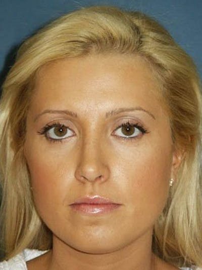 Female Rhinoplasty Before & After Gallery - Patient 17365786 - Image 2