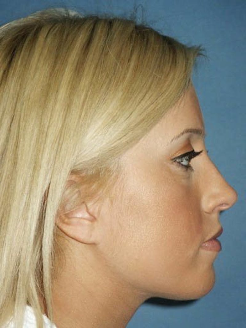 Female Rhinoplasty Before & After Gallery - Patient 17365786 - Image 3