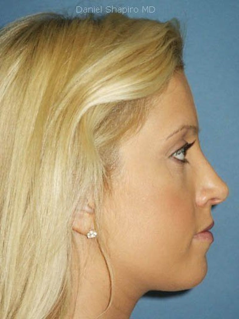 Female Rhinoplasty Before & After Gallery - Patient 17365786 - Image 4