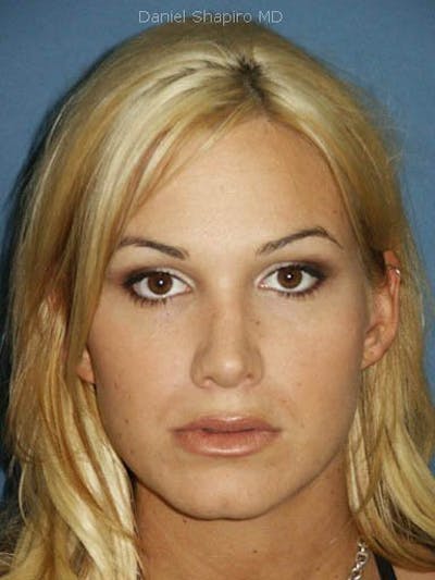 Female Rhinoplasty Before & After Gallery - Patient 17365788 - Image 2