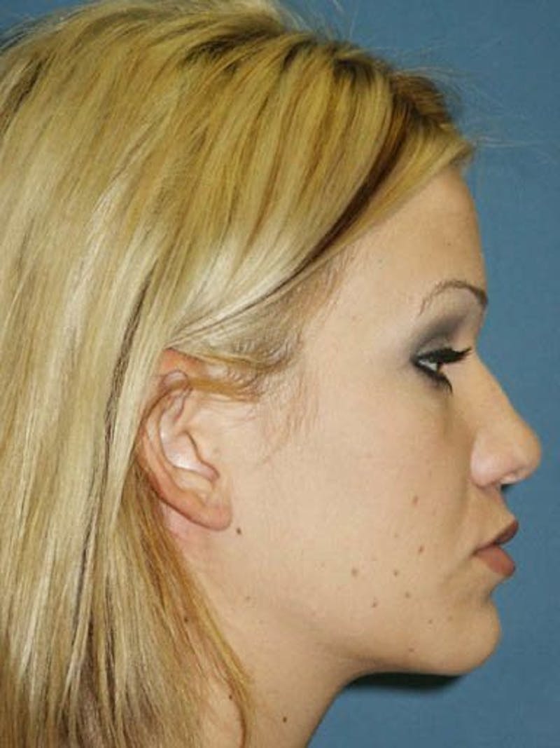 Female Rhinoplasty Before & After Gallery - Patient 17365788 - Image 3