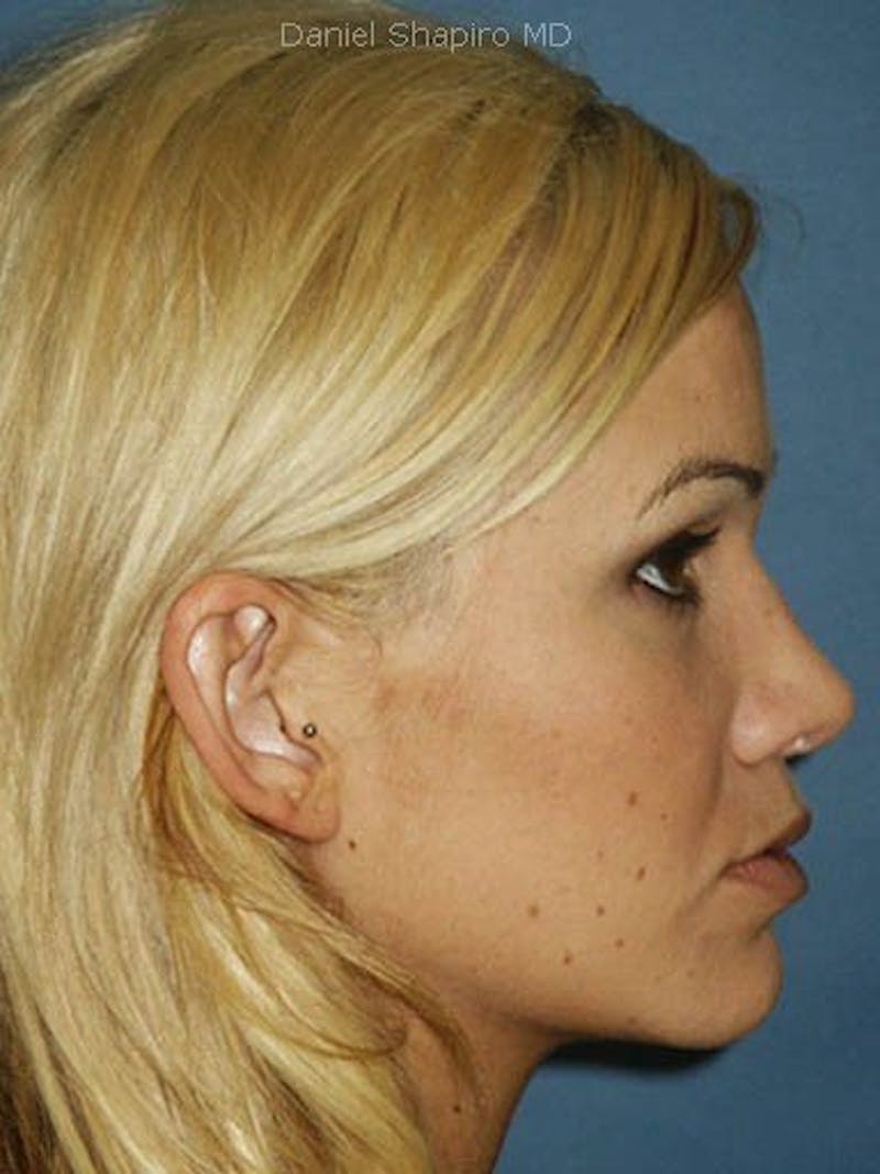 Female Rhinoplasty Before & After Gallery - Patient 17365788 - Image 4