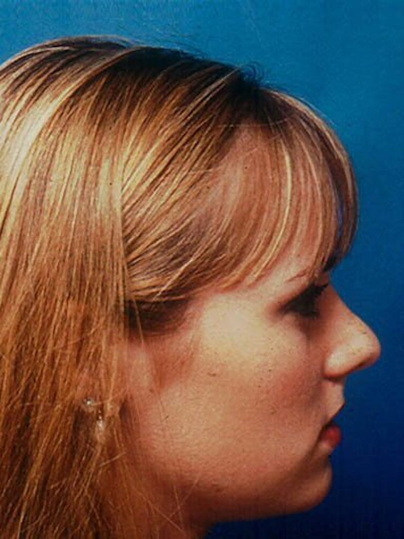 Female Rhinoplasty Before & After Gallery - Patient 17365789 - Image 3