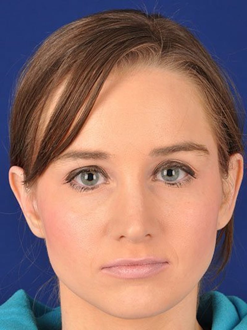 Female Rhinoplasty Before & After Gallery - Patient 17365792 - Image 1