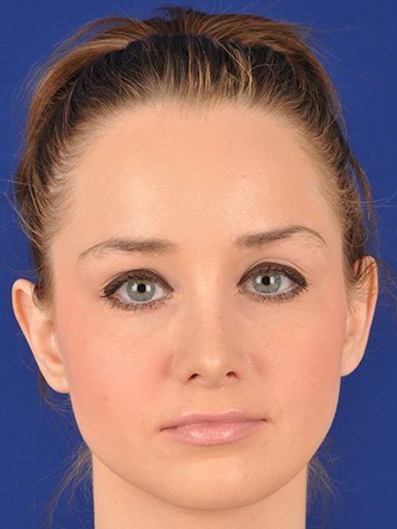 Female Rhinoplasty Before & After Gallery - Patient 17365792 - Image 2