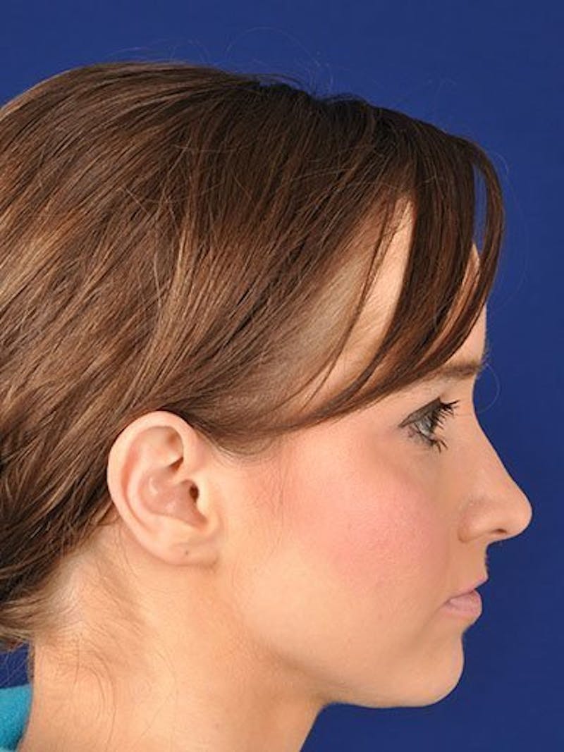 Female Rhinoplasty Before & After Gallery - Patient 17365792 - Image 3