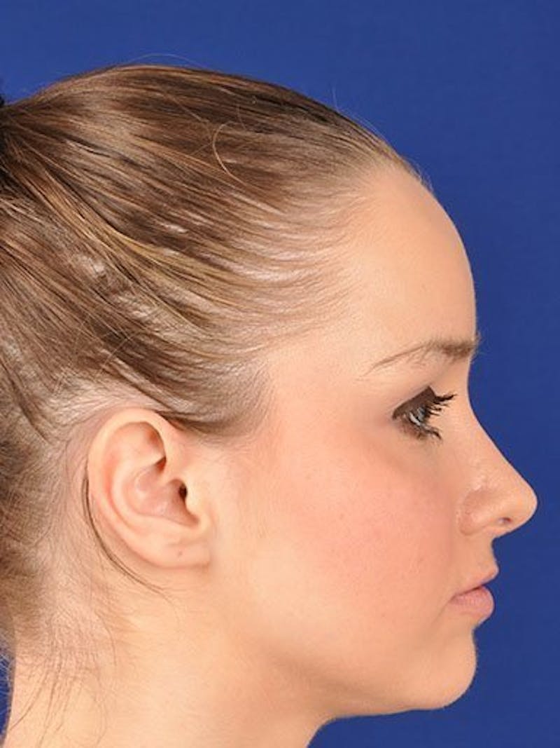 Female Rhinoplasty Before & After Gallery - Patient 17365792 - Image 4