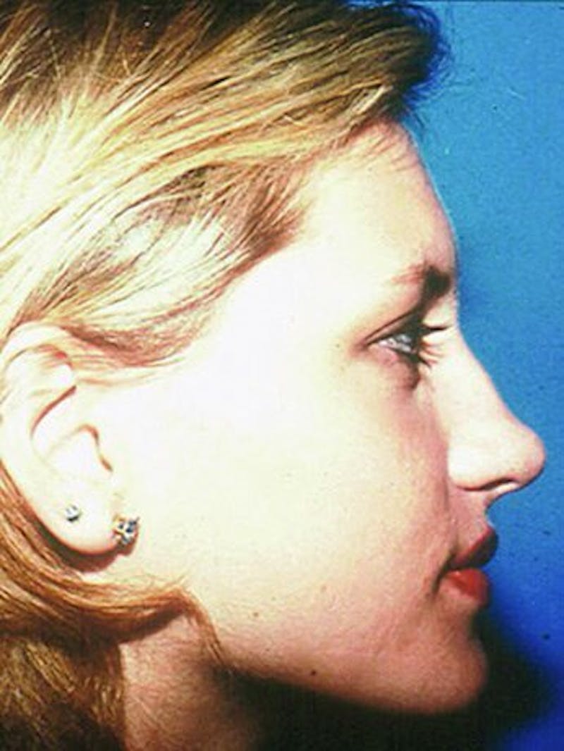 Female Rhinoplasty Before & After Gallery - Patient 17365795 - Image 3
