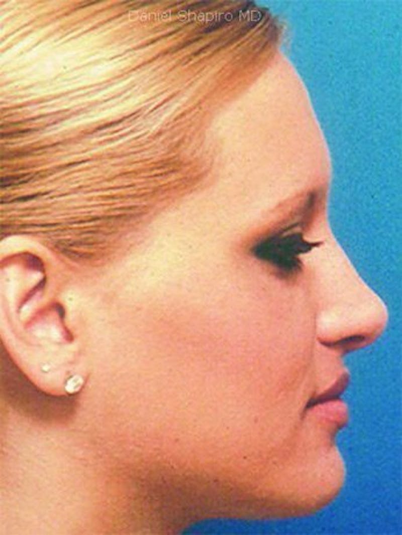Female Rhinoplasty Before & After Gallery - Patient 17365795 - Image 4