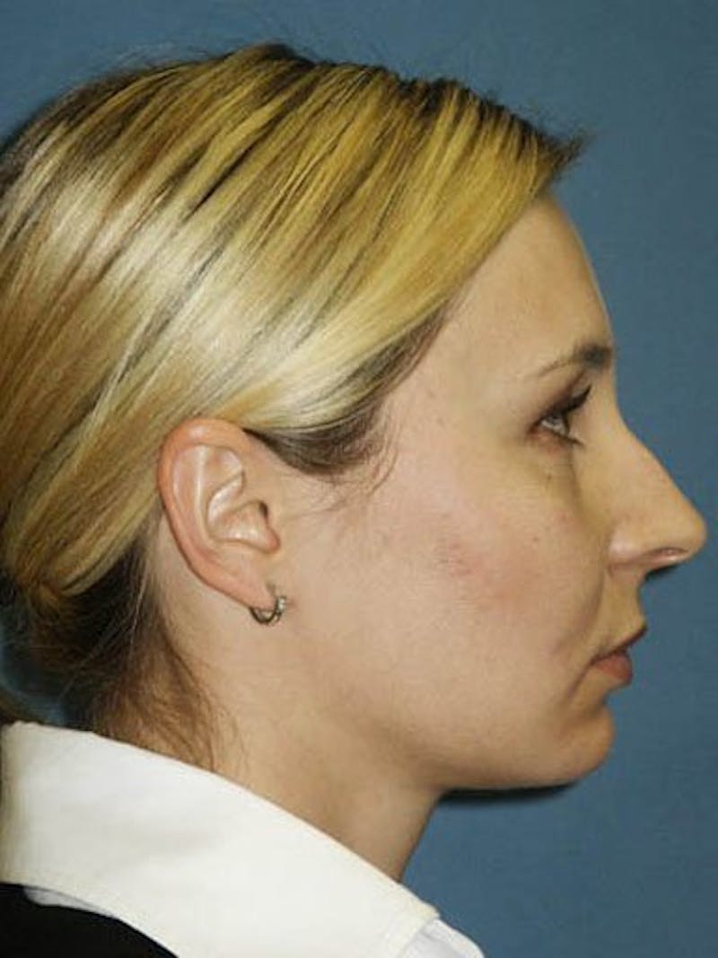 Female Rhinoplasty Before & After Gallery - Patient 17365796 - Image 3